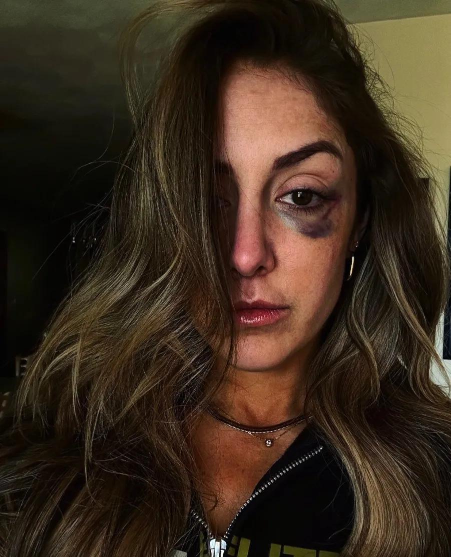 Britt baker black eye